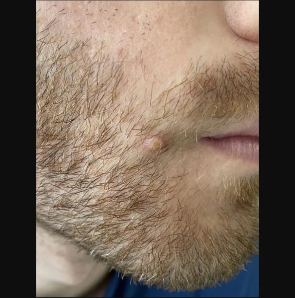 Houston man with monkeypox on face believes a kiss caused it